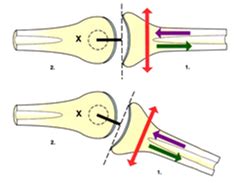 When Convex-Concave Rule Meets Clinical Practice - iOrtho+®