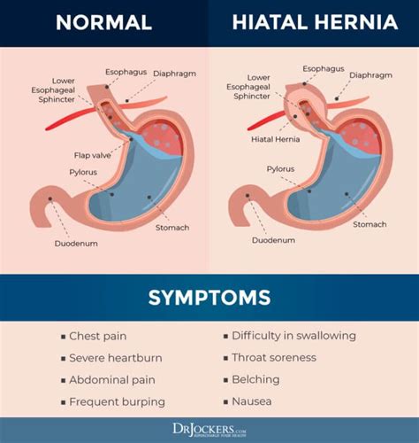 Hiatal Hernia: Symptoms, Causes and Natural Support Strategies in 2021 ...