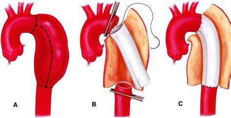 Thoracic Aortic Aneurysms | Cardiac Health