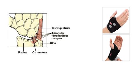 TFCC Ulnar Sided Wrist Pain Anatomy, Diagnosis Treatment, 46% OFF