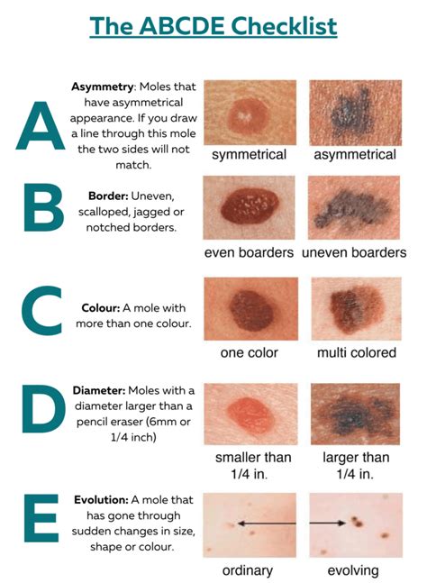 Melanoma Mole Vs Normal Mole