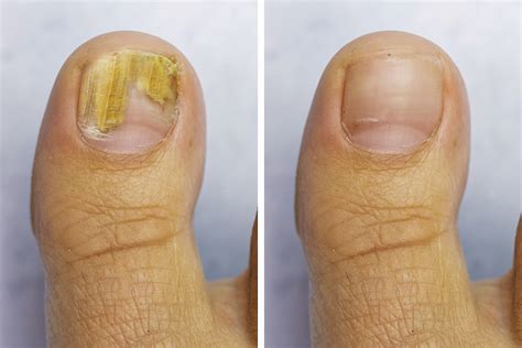 Nail Fungus – Riverina Podiatry Group