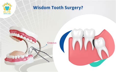 Wisdom Tooth Surgery: Everything You Need to Know! | Elite Dental Care