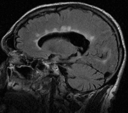 Multiple sclerosis | Radiology Reference Article | Radiopaedia.org