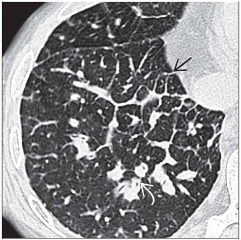 Diffuse Pulmonary Lymphangiomatosis | Radiology Key