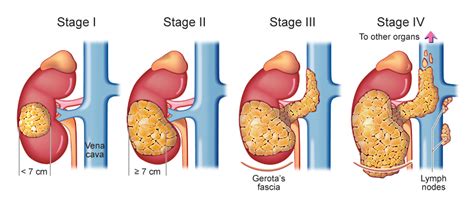 Renal Cell Carcinoma | Urology Surgeon