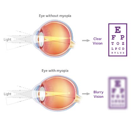 Myopia Control & Management | Lighthouse Vision | Milford, CT