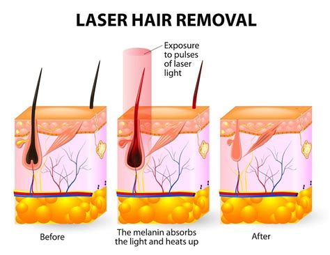 Laser Hair Removal Treatment in Mumbai and Delhi, India | Permanent ...