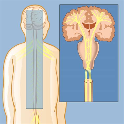 Spasticity | Weill Cornell Brain and Spine Center