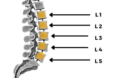 Lumbar L3-L4 disc herniation