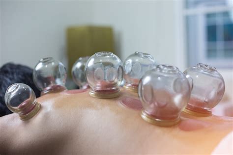 Cupping Therapy - Katie Gaffney, OMD, L.Ac.