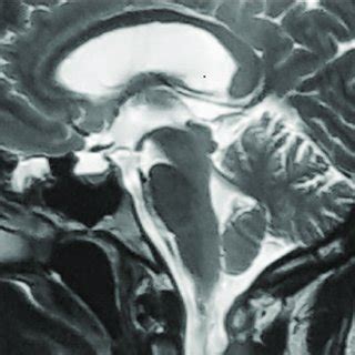 After performing a valveless lumboperitoneal shunt, the cerebral MRI in ...