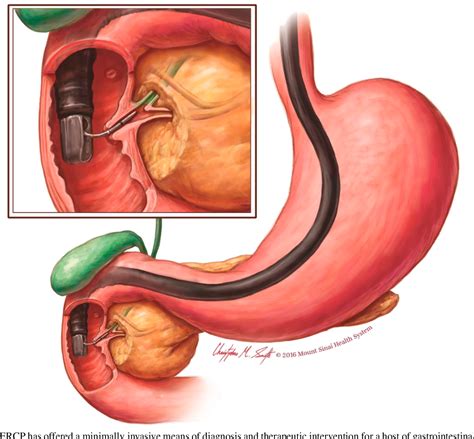 Analysis of Endoscopic Retrograde Cholangiopancreatography in Rural ...