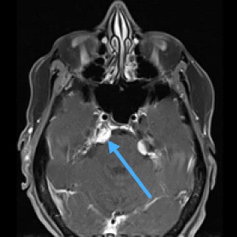 Patient with acute isolated right 6 th cranial nerve palsy. Head CT ...