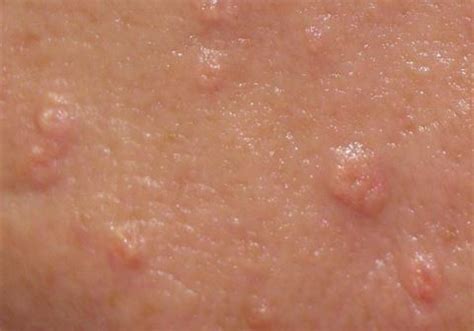 Sebaceous Hyperplasia - Treatment, Photos, Removal, Causes