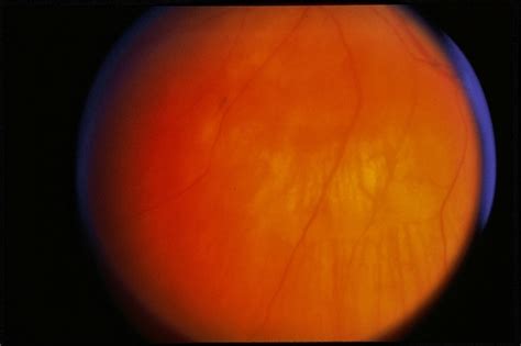 Choroidal Hemangioma / RD - Retina Image Bank