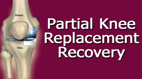 Partial Knee Replacement Recovery - YouTube