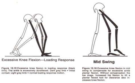 prosthetic gait deviations Flashcards | Quizlet