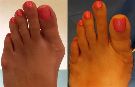 Bunion Surgery - OC Podiatry