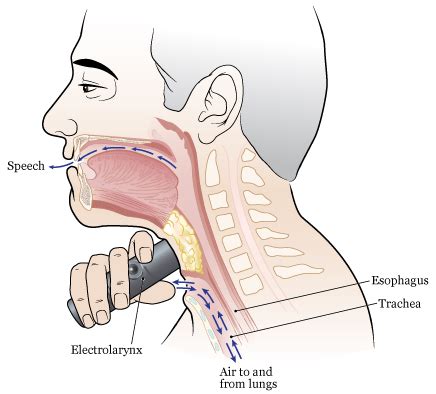 Laryngectomy Anatomy