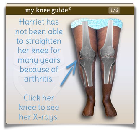 Harriet: Large bone spurs were removed from the back of Harriet’s knee ...