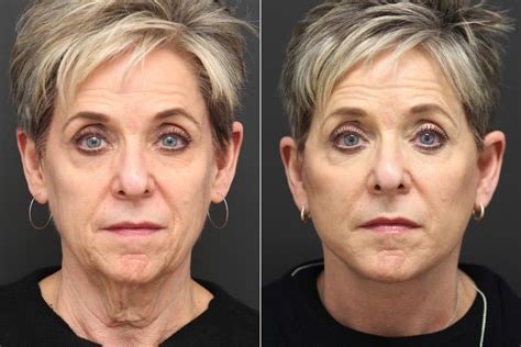 Facelift and Mini Facelift Surgeries in New Jersey