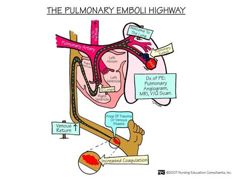 Pulmonary embolism