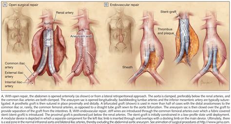 A 66-Year-Old Man With an Abdominal Aortic Aneurysm: Review of ...