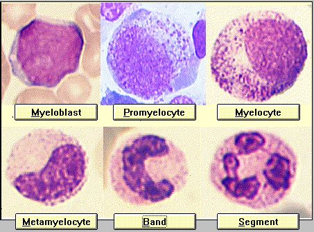 Myelocyte Vs Promyelocyte | Medical laboratory scientist, Medical ...