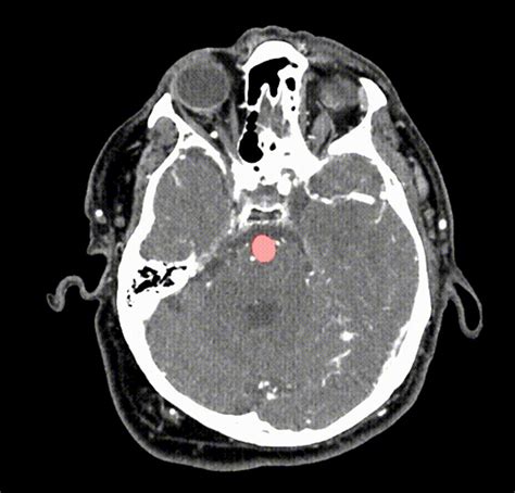 Brain Aneurysm Ct Scan - Diagnosis of a brain aneurysm may require ct ...