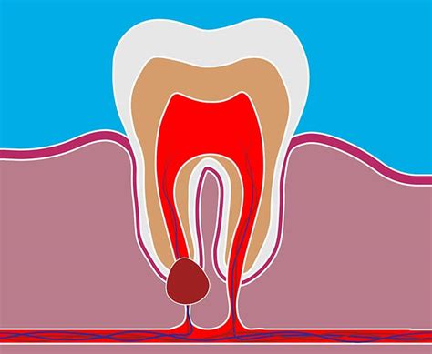 Wisdom Tooth Cyst On Gum