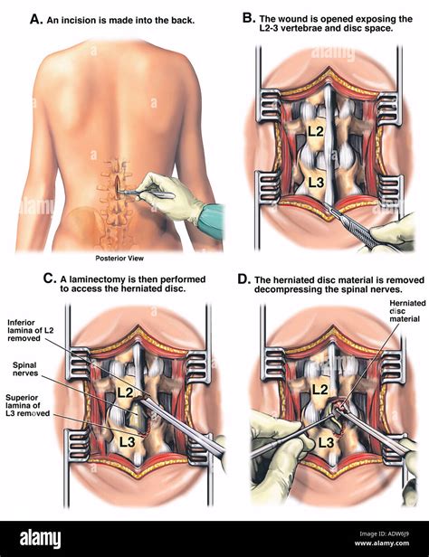 L2-3 Disc Herniation with Laminectomy and Discectomy Stock Photo ...