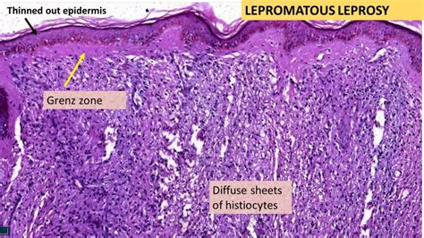 LEPROSY- Tuberculoid & Lepromatous | Pathology Made Simple