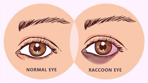 Raccoon Eyes Condition - Its Symptoms, Causes, Complications and More