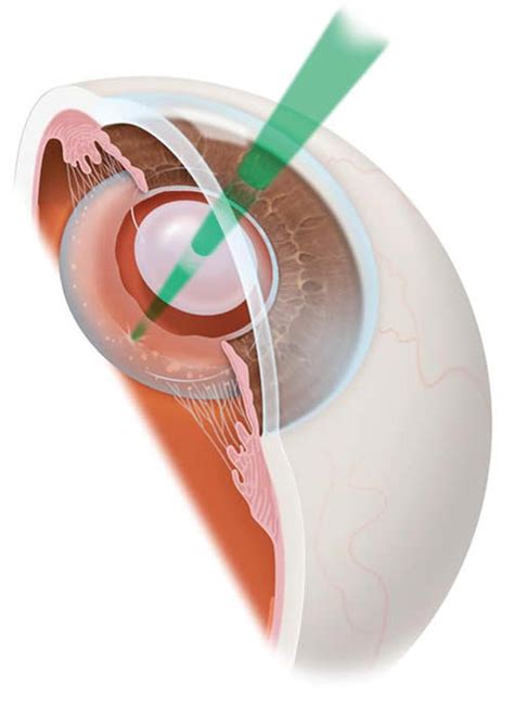 YAG Capsulotomy Procedure · Top Eye Doctor, NYC Ophthalmology