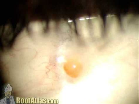 Pyogenic Granuloma On Eyelid Treatment