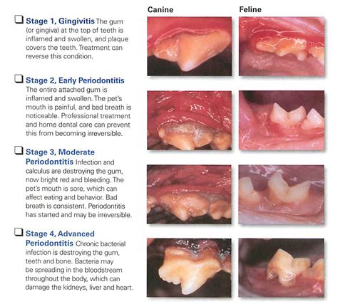 Here's What You Need to Know About the Stages of Periodontal Disease ...