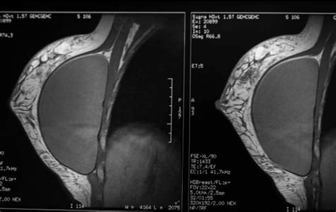 How To Spot Breast Implants - Agentcommon17