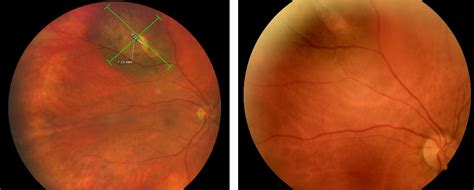 Choroidal Nevus With Lipofuscin