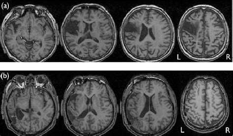 MRI revealed the presence of brain injury in Case 1 (a) and Case 2 (b ...