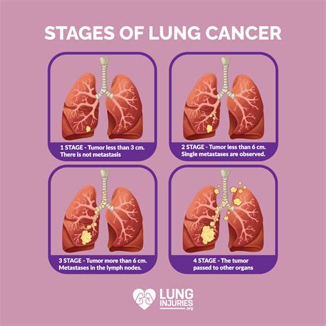 Stages Of Lung Cancer Chart