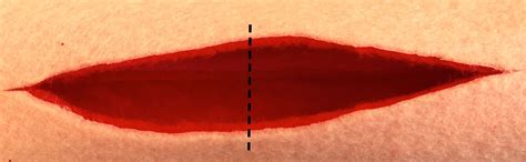 Veterinary Key Points: Closure of Elliptical Incisions in Dogs: The ...