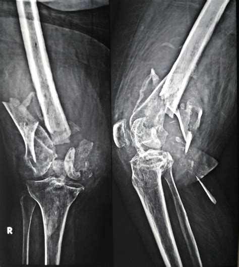 Distal Femoral Fracture