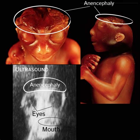 Anencephaly Ultrasound