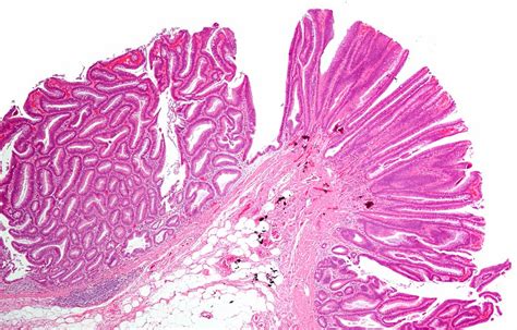 Quiz:Gastrointestinal polyps 1 - Libre Pathology