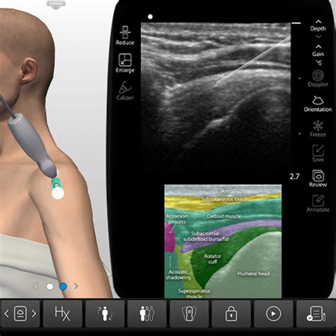 Subacromial Injection - Subacromial Shoulder Injection Ultrasound