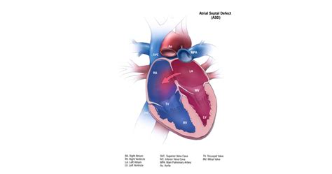 ASD Closure Device | ASD Catheter | ASD Treatment