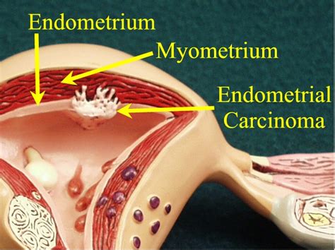 Endometrial Carcinoma