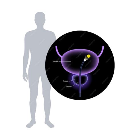 Premium Vector | Cystoscopy is a minimally invasive procedure ...