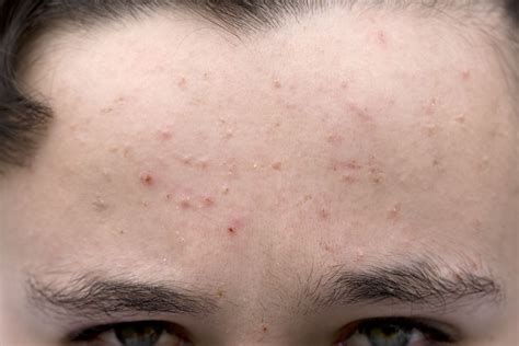 What Is Moderate Acne? How Severe Is My Acne?